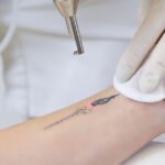 Tattoo Removal and Age