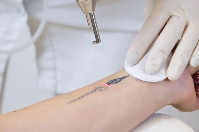 Tattoo Removal and Age