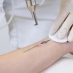 Tattoo Removal_ Understanding Methods and Considerations