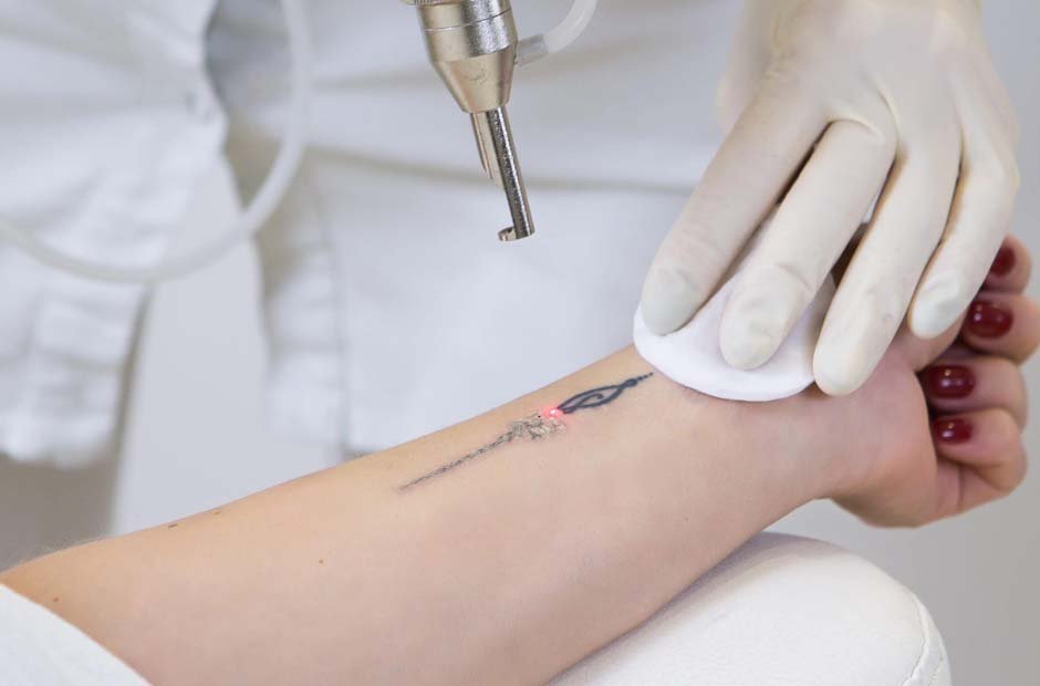 Tattoo Removal_ Understanding Methods and Considerations