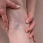 Leave Varicose Veins Untreated