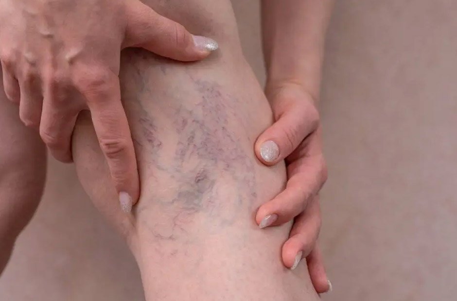 Leave Varicose Veins Untreated