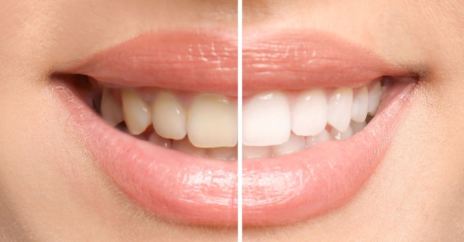 How To Make Your Teeth Healthy Again After Damage Or Decay